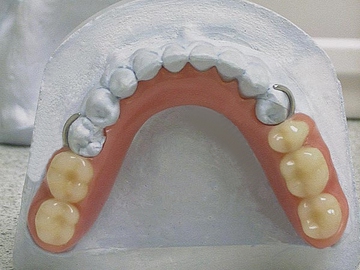Протезы бюгельного типа