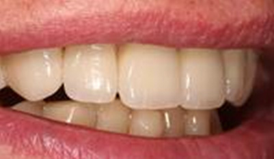 Как ухаживать за циркониевыми коронками