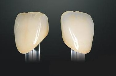 Безметалловая керамика в Москве