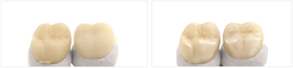 Цельноциркониевые коронки изготовлены из диоксида циркония