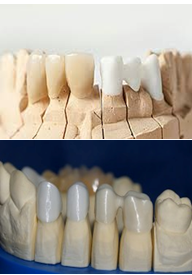 установка циркониевых коронок на жевательные зубы