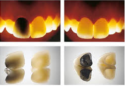 Плюсы циркониевых коронок