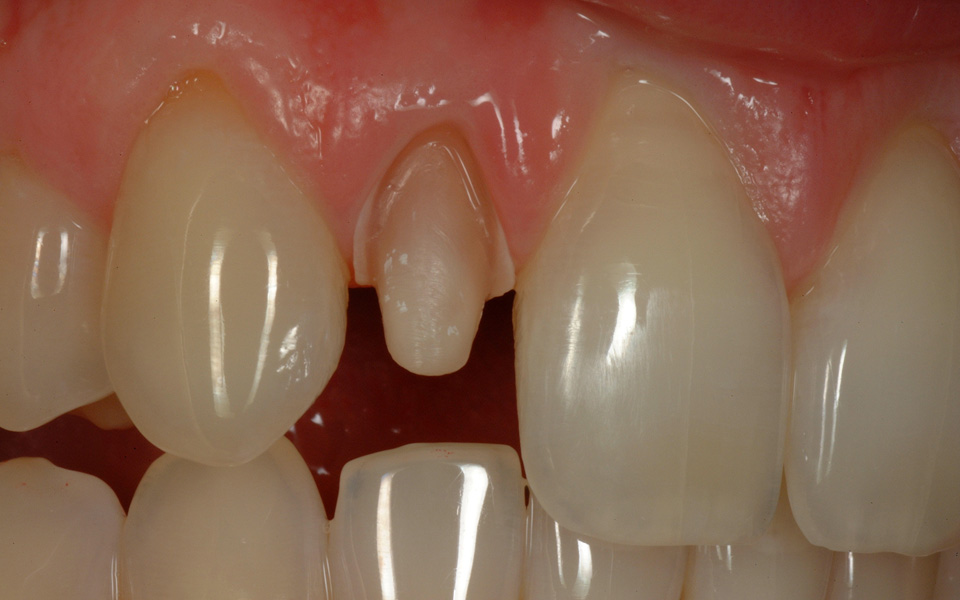 изготовление керамических коронок в стоматологии Апекс-Д