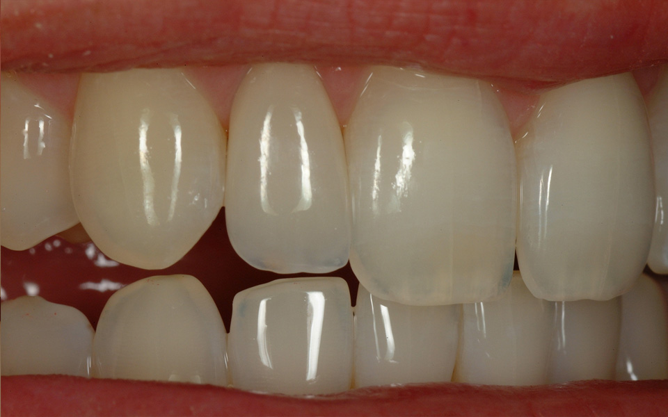 цельнолитая керамические коронки 