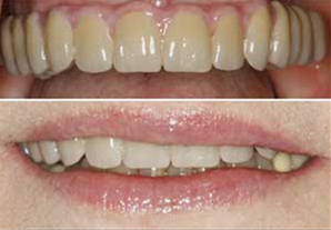 Полный протез на верхнюю челюсть. Цены на dental-implantology.ru