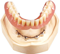 Балочный протез на 4 имплантах
