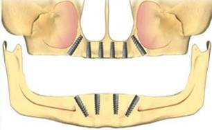 Несъемный протез на 6 имплантах
