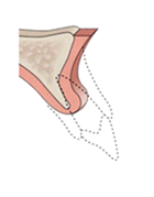 Расщепление альвеолярного гребня