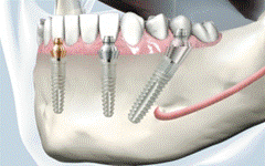 Балочные протезы на имплантатах