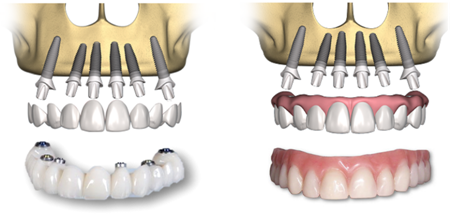 Схема условно съемного протеза на 6 имплантах