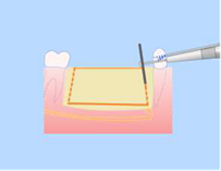 Расщепление альвеолярного гребня