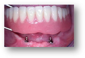 Описание: Описание: Картинки по запросу all on 4 implant