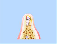 Расщепление альвеолярного гребня