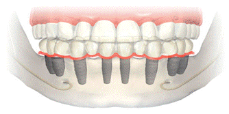 мосты на верхнюю и нижнюю челюсть