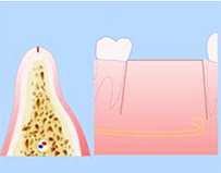 Расщепление альвеолярного гребня