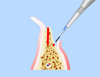 Расщепление альвеолярного гребня