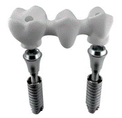 мост на имплантах 