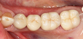 мосты на имплантах фото у женщин