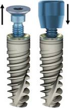 Составные части импланта зуба