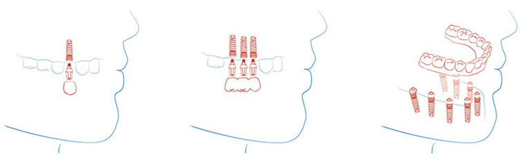 Импланты зубов дешево в Москве
