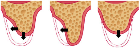 Наращивание кости для имплантации зубов на dental-implantology.ru