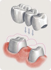 конструкция мостовидного протеза