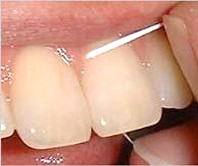 уход за мостовидными протезами