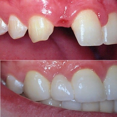 свойства мостовидных протезов