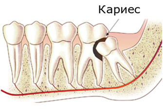 Лечение кариеса зуба мудрости