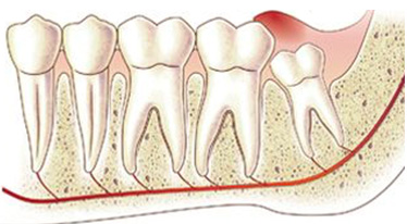 Перикоронит зуба мудрости на верхней и нижней челюсти